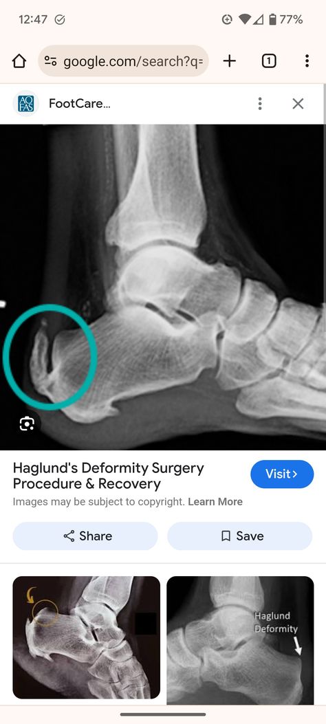 Haglunds Deformity