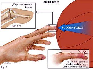 Jammed Finger, Mallet Finger, Finger Injury, Physical Disabilities, Medical Terminology, Hand Therapy, Therapy Tools, Occupational Therapy, Health Facts