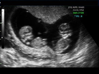 Miracles sonogram Twin Ultrasound, Twins Ultrasound, Baby Ultrasound Pictures, Having Twins, Ultrasound Technician, Raising Twins, Baby Ultrasound, Pregnancy Apps, Twin Baby Girls