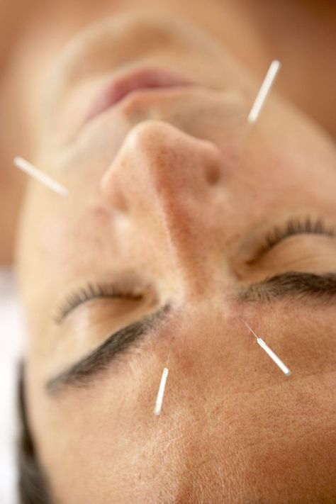 Do you want to learn about the benefits of using facial acupuncture and how it works? Read on to learn how acupuncture can help treat acne. To learn more, call (415) 855-3112 Facial Acupuncture, Different Types Of Acne, Heart Opening, Acne Help, Female Fertility, Types Of Acne, Acne Causes, Treat Acne, Scar Tissue