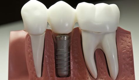 Lowest Dental Implants Cost in Brandon at Chancellor Dental Dental Crown Procedure, Tooth Implant, Bone Grafting, Dental Implant Surgery, Dental Implants Cost, Wisdom Teeth Removal, Tooth Replacement, Restorative Dentistry, Emergency Dentist