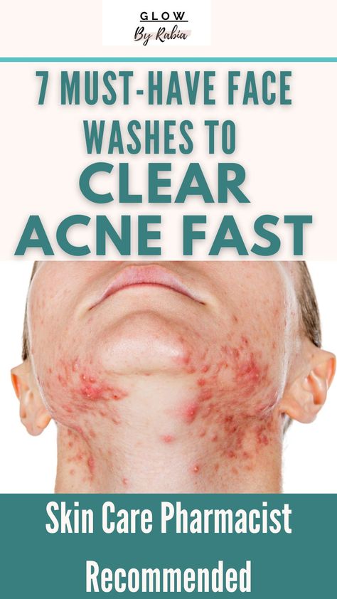 Face Wash For Acne Prone Skin, Best Acne Face Wash, Best Skincare Products For Acne, Face Wash Products, Best Face Wash For Acne, Best Products For Acne, Skincare Products For Acne, Clear Acne Fast, Face Wash For Acne