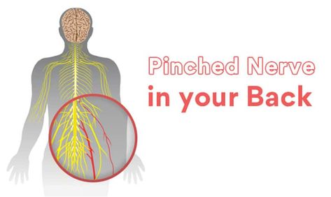 Discover the duration and relief options for pinched nerves – How long does a pinched nerve last and what you can do about it. - #Durationofatrappednerve #Durationofpinchednerverecovery #Howlongdoesacompressednervelast #Pinchednervehealingtime #Pinchednerverecoveryperiod #Pinchednervesymptomduration Nerve Conduction Study, Bulging Disc, Nerve Health, Pinched Nerve, Muscle Weakness, Magnetic Resonance, Nerve Damage, Good Posture, Nerve Pain