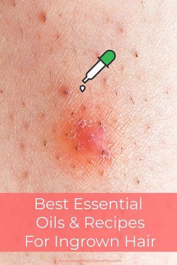 Ingrown Eyebrow Hair, Infected Hair Follicle, Infected Ingrown Hair, Treat Ingrown Hair, Hair Oil Recipe, Ingrown Hair Serum, Ingrown Hair Remedies, Nail Remedies, Prevent Ingrown Hairs