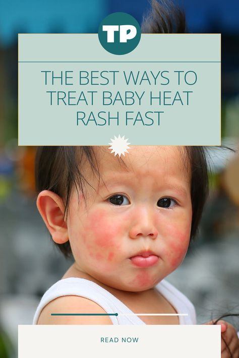 baby with heat rash on its cheeks, how to deal with baby heat rash Baby Heat Rash, Sick Kids Hospital, Prickly Heat, Heat Rash, How To Read Faster, Sweat Gland, Tropical Holiday, Do Baby, Bacterial Infection