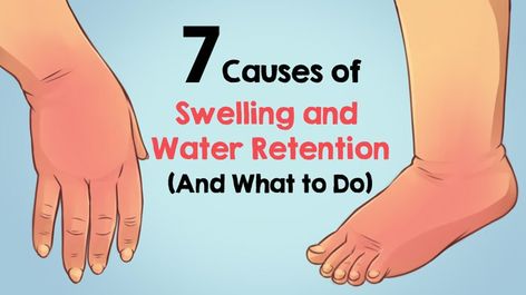 Water retention, also known as fluid retention or edema, occurs when excessive amounts of fluid build up inside the body. It can occur in the circulatory system or within tissues and cavities throughout the body. The result is swelling in the hands, feet, ankles and legs. There are several possible causes of water retention, most of which are not too serious or out of the ordinary. For example, it’s very common for some women to experience the condition during pregnancy or before their ... Retaining Water Remedies, Getting Rid Of Water Retention, Feet Swelling Causes, Ankle Swelling Causes Of, How To Get Rid Of Water Retention, How To Reduce Swelling In Feet Fast, Fluid Retention Remedies, Water Retention Causes, Swelling Remedies