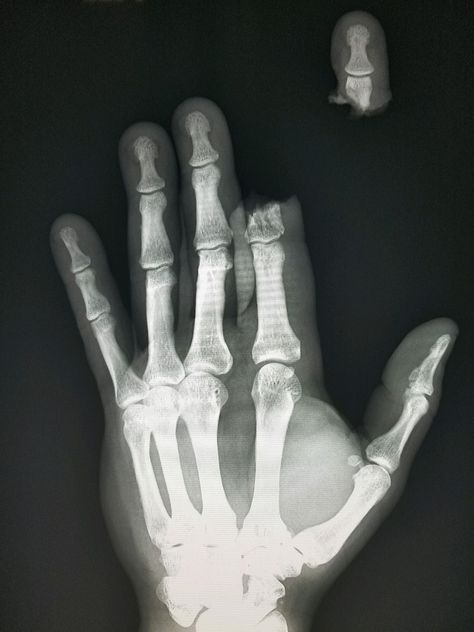 #Hand #Xray shows severed #finger in a #chainsaw #accident.  #radiology #radiologist #pain #injury #trauma #powertool Hand Xray, Severed Finger, Finger Injury, Vegetarian Fast Food, Radiology, X Ray, Chainsaw, Rats, Film