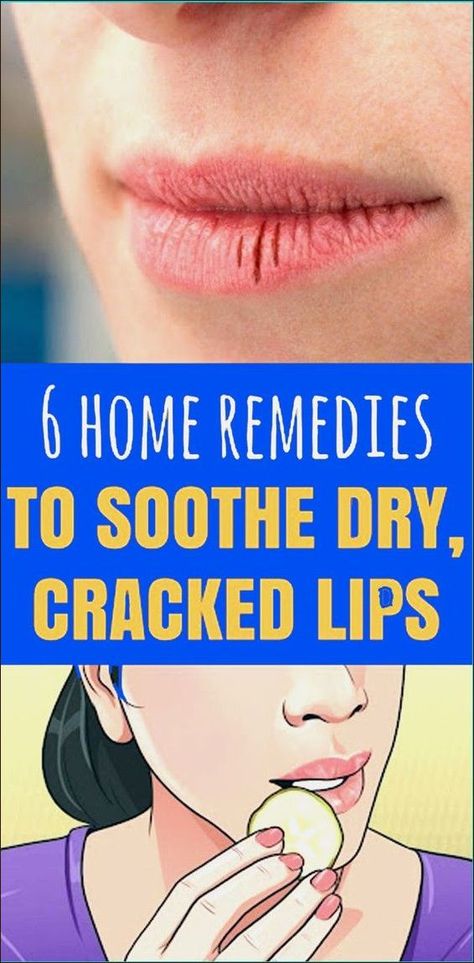 Here Are 6 Home Remedies To Soothe Dry Cracked Lips Remedies For Chapped Lips, Dry Lips Remedy, Chapped Lips Remedy, Dry Cracked Lips, Health Articles Wellness, Health Signs, Health Activities, Cracked Lips, Healing Modalities