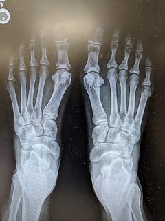 Lisfranc Injury Recovery, Lisfranc Injury, Ankle Surgery, Ligament Tear, Broken Ankle, Medical Leave, Injury Recovery, Ankle Injury, Scar Tissue