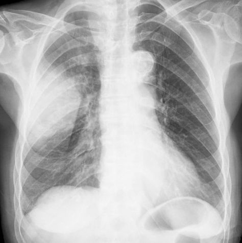 Alcoholic elderly patient with Klebsiella pneumoniae. Pneumonia shows a dense right upper lobe consolidation. STATdx Klebsiella Pneumoniae, Upper Lobe, X Ray, Antonio Mora Artwork, Abstract Artwork