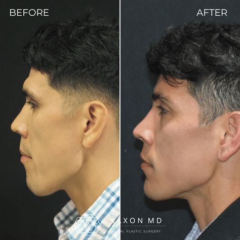 Can men get a brow bone reduction? Absolutely! This procedure isn’t just for women—it’s also an option for men looking to soften a prominent brow ridge or reduce an intense look. Learn why this happens and how brow bone reduction can help in our blog. 🌟  #BrowBoneReduction #FacialAesthetics #CosmeticSurgeryForMen #FacialRejuvenation #DrSaxon #AustinTX #DallasTX #DrippingSpringsTX #PlasticSurgeryTips Ipl Photofacial, Facial Bones, Laser Skin Resurfacing, Reduction Surgery, Facial Aesthetics, Neck Lift, Facial Rejuvenation, Skin Resurfacing, Brow Lift