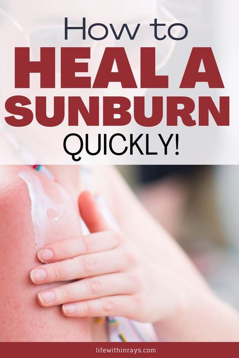 10 effective ways to heal a sunburn Severe Sunburn Remedies, Coconut Oil For Sunburn, Best Remedy For Sunburn, Best Sunburn Relief, Sunburn Cream, Best For Sunburn, How To Help Sunburn, Home Remedies For Sunburn, Get Rid Of Sunburn