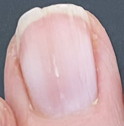 Split Fingernails Remedies, How To Stop Nails From Splitting, Repair Split Nail, Nail Splitting Down The Middle, How To Fix A Split Fingernail, Nail Ridges Vertical Warning Signs, Splitting Nails Remedies, Finger Nails Health, Hang Nail Remedy