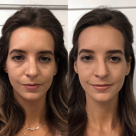 Remove Under Eye Bags, Botox Under Eyes, Jaw Reduction Surgery, Cosmetic Fillers, Plastic Surgery Fail, Under Eye Fillers, Botox Before And After, Face Surgery, Plastic Surgery Gone Wrong