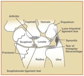 Tom's Physiotherapy Blog: Wrist Injuries Part 2 Acdf Surgery, Nerve Anatomy, Basic Anatomy, Wrist Injury, Ligament Tear, Sports Therapy, Sprained Ankle, Hand Therapy, Joints Pain Relief