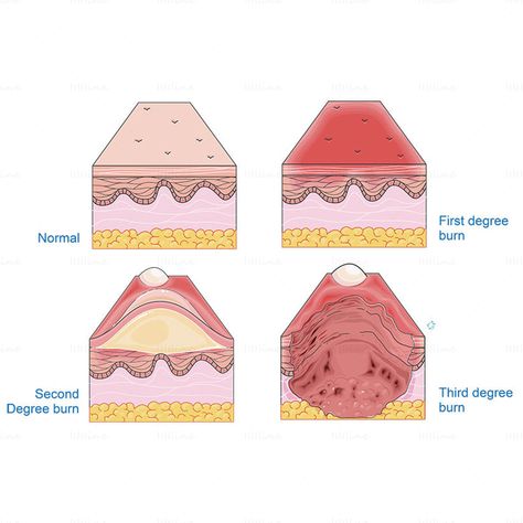 Burned Skin Drawing, First Degree Burn, Second Degree Burn, Third Degree Burn, Types Of Burns, 2nd Degree Burns, Degree Burns, Skin Drawing, Nursing School