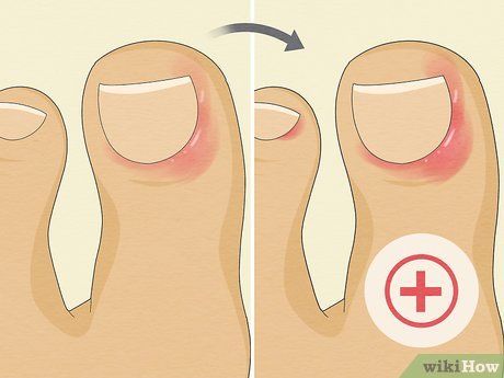 Infected Cuticle, Infected Toenail, Toenail Fungal Infection, Kidney Pain, Nail Problems, Nail Infection, Animal Print Nails, Fungal Infection, Nail Health