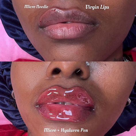 NO FILTER JUST FILLER 😍 APPOINTMENTS & TRAININGS available for lip filler services 😍 100% Hyaluronic Acid No Pain | No Downtime Natural Alternative Lasts 12 + Months With Proper Care 20-30 Min Procedure Filler Black Women, Lip Filler Business, Hyaluronic Acid Lips, Lip Filler, Face Exercises, Lip Fillers, No Filter, Beauty Bar, Body Works