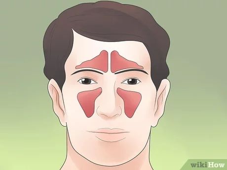 3 Ways to Stop Sinus Headaches - wikiHow Health Sinus Headache Remedies, Sinus Pressure Headache, Drain Sinuses, Sinus Pressure Relief, Sinus Headache Relief, Dry Sinuses, Sinus Remedies, Relieve Sinus Pressure, Getting Rid Of Headaches