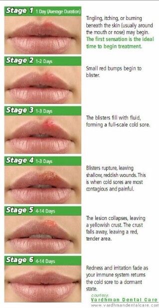 Cold sore stages Lip Sores, Cold Sore Stages, Cold Sore Lip, Cold Sore Remedy, Sore Lips, Fever Blister, Cold Sore Remedies, Canker Sore, Cold Sores Remedies