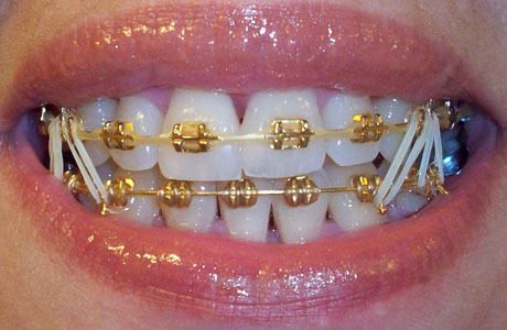 I wish I would have gotten these. Str8 thugin! Smile With Braces, Bijoux Piercing Septum, Gold Braces, Natural Teeth Whitening Diy, Cute Braces Colors, Braces Tips, Getting Braces, Braces Girls, Invisible Braces