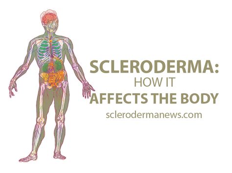 The symptoms of scleroderma vary greatly from person-to-person, and not all patients develop all complications. Learn some of them here. Scleroderma Symptoms, Autoimmune Disease Quotes, Scleroderma Awareness, Disease Quote, Agent Orange, Swollen Legs, Awareness Quotes, Tighter Skin, Autoimmune Disease