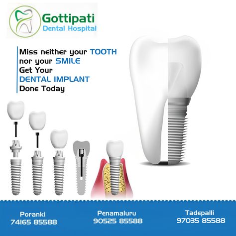 Get Your DENTAL IMPLANT Done Today For More Details Visit Our Gottipati Dental Hospital In Vijayawada #Dentalhospitalinvijayawada #Braces #Metalcrowns #Teethwhitening #Implants #Rootcanals Dental Implants Creative Ads, Medical Ads, Dental Hospital, Dental Implant, Creative Ads, Dental Implants, Dental Care, Braces, Happy Mothers