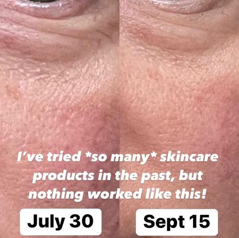 🌟 **WOW, JUST WOW!!** 🌟 I’ve tried *so many* skincare products in the past, but nothing worked like this! After almost 2 months of using waterless skincare, my under-eyes are noticeably brighter, smoother, and those fine lines? They’re fading away! 🙌 Not to mention my overall skin texture—it’s SO much smoother, and my pores are shrinking! 🙏💕 Water-based skincare is a thing of the past for me. Ditch the water and make the switch to **Hydroxytyrosol** for glowing, hydrated skin. Trust me, i... Waterless Skincare, Hydrated Skin, The Switch, Skin Texture, 2 Months, Hydrate Skin, Trust Me, A Thing, Skincare Products