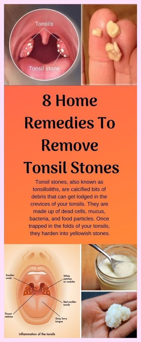 Swollen Tonsils, Tongue Health, Oral Health Care, Tooth Decay, Oral Hygiene, Oral Health, Oral Care, Home Remedies, Natural Remedies