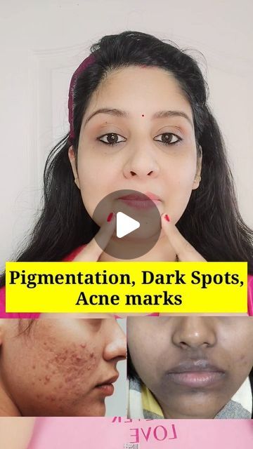 Pigmentation Remedy, Turmeric Uses, Dark Spots Remedies, Tere Bina, Cream For Dark Spots, Dark Spots On Face, Face Cleaning, Spots On Face, Face Acne