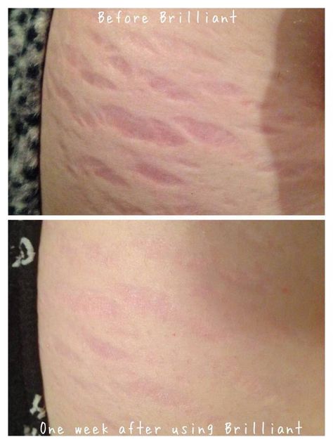 www.youniqueproducts.com/lisaward Rash On Face, Stretch Mark Removal, Stretch Mark Cream, Stretch Mark, Younique Makeup, Gel Moisturizer, Daily Moisturizer, Skin Care Regimen, Skin Elasticity