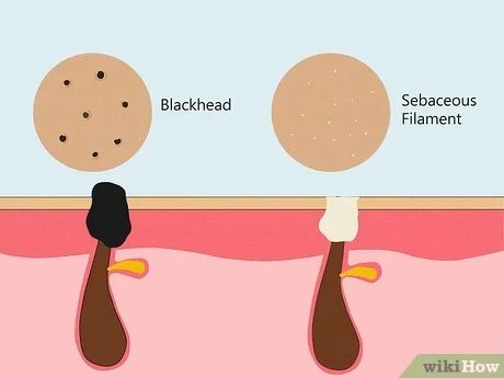 How to Get Rid of Sebaceous Filaments: 7 Effective Methods Sebatious Filaments, How To Get Rid Of Sebaceous Filaments, Sebaceous Filaments Removal, Sebaceous Filaments, Salicylic Acid Cleanser, Harvard Medical School, Get Rid Of Blackheads, Retinol Serum, Oil Cleanser