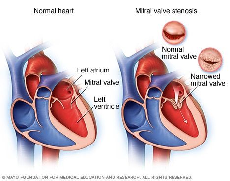 Mitral Valve Regurgitation, Aortic Valve Replacement, Mitral Valve, Heal Thyself, Penyakit Jantung, Heart Valves, Normal Heart, Open Heart Surgery, Congenital Heart