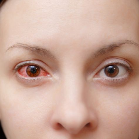 Close up of one annoyed red blood and health eye of female affected by conjunctivitis or after flu cold or allergy in... Red Eyes Remedy, Treating Pink Eye, Pink Eye Home Remedies, Pinkeye Remedies, Allergy Eyes, Cold Or Allergies, Irritated Eye, Eye Vitamins, Eye Infections