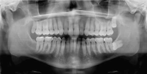 Dental X-ray2 by nantel, via Flickr Oral Pathology, Kedokteran Gigi, Teeth Bleaching, Dental Humor, Root Canal, Healthy Smile, Dental Assistant, Dental Hygiene, Cosmetic Dentistry