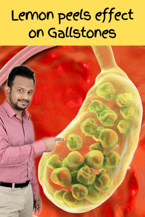 gallstones,gallstones symptoms,gallstones treatment,dissovle gallstones,gallstones natural remedies,gallstones causes,gallstone cleanse recipe,gallstone food,gallstone healing,gallbladder detox,detox gall bladder,gallstone lemon juice,gallstone liver flush,gallstone flushing,gallbladder stone removal naturally,gallbladder stones causes,gallbladder stones remedies,gallbladder disease,gallbladder detox recipe,what causes gallstones,prevent gallstones How To Get Rid Of Gall Stones Naturally, How To Dissolve Gallbladder Stones, Gall Stones Remedy Natural Treatments, Gall Bladder Symptoms, Gall Stones Remedy, Gallstone Cleanse, Gallbladder Stones Diet, Gall Bladder Cleanse, Gallbladder Attack Symptoms