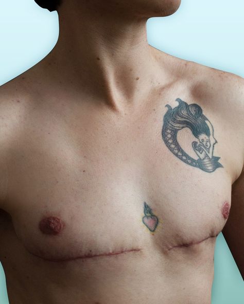 Mastectomy Scars, Tattoo Over Scar, Top Surgery, Fake Freckles, Skin Tattoo, Trans Art, Trans Boys, First Boyfriend, Tattoo Cover