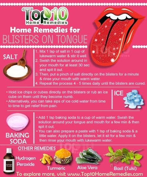 Home Remedies for Blisters on Tongue. You can try some natural #homeremedies to help alleviate the pain and inflammation caused b tongue blisters. Here are #top10homeremedies to promote faster healing. Blister On Tongue, How To Heal Blisters, Tongue Sores, Ice Chips, Top 10 Home Remedies, Canker Sore, Tongue Health, Holistic Remedies, Cold Sore