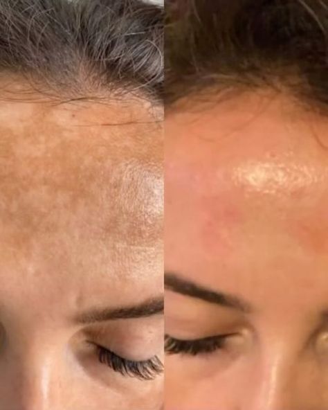 Microneedling Before And After, Best Stretch Mark Removal, Facial Before And After, For Brightening Skin, Stretch Mark Removal Cream, Acne Scarring, Beautiful Skin Care, Body Acne, Brightening Skin