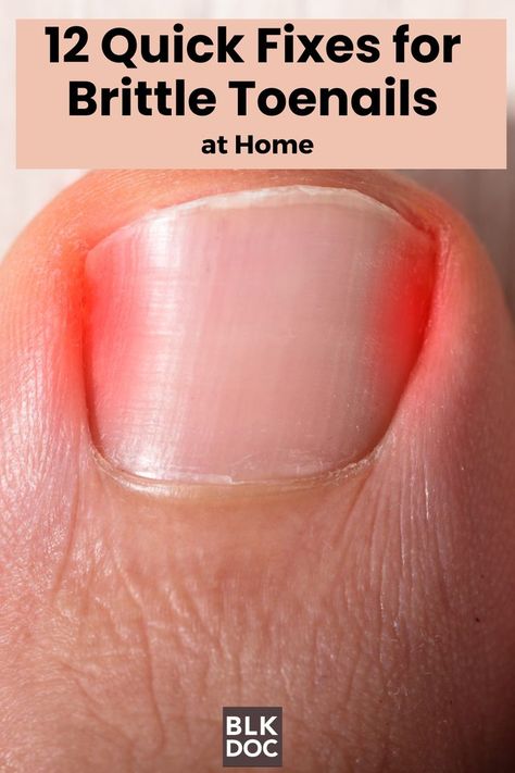 Brittle Toenails at Home Ridges On Toenails, Broken Toenail, Brittle Toenails, Toenail Removal, Toenail Health, Black Doctor, Nail Oil, Brittle Nails, Find Work