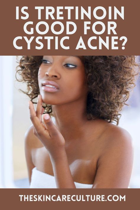 Is Tretinoin Good for Cystic Acne? Tretinoin Acne, Tretinoin Before And After, Before And After Acne, Home Facial Treatments, Anti Aging Secrets, Acne Solutions, Cystic Acne, Anti Aging Facial, Anti Aging Treatments