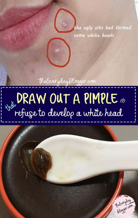 #DrawOutaPimple - A blind pimple is an under the skin pimple with no head, this remedy will help to flush the area and draw the pimple to the surface of the skin & is ready to be drained without much effort. Ingrown Pimple, Hard Pimple, Deep Pimple, Zit Remedy, Painful Pimple, Drawing Salve, Cystic Pimple, Blind Pimple, Pimples Under The Skin