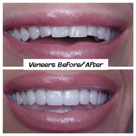 Best Veneers Teeth, Veneers Before And After, Teeth Makeover, Natural Veneers, Perfect Smile Teeth, Dental Makeover, Grow Back Receding Gums, Whiten Teeth Fast, Pretty Teeth