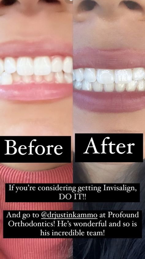 Savannahwithacamera Invisalign Straight Teeth Invisalign, Invisalign Aesthetic, Straight Teeth, 2025 Vision, Art Poses, Vision Board, The Incredibles, Wonder, Collage