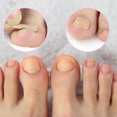 Toenail Pain, Ugly Toenails, Ingrown Nail, Nail Repair, Ingrown Toe Nail, Nail Growth, Nail Fungus, Homemade Remedies, Pedicure Tools