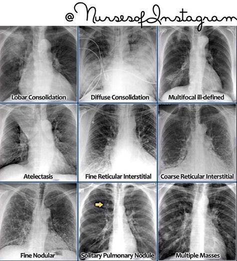 Educational blurb! These images really help match an image to a diagnosis to help it all make sense! #Radiology #Reports #Pna #Nodule #Pulmonary #Lungs #Respiratory #Consolidation #Diffuse #Focal #Multifocal #NerdLife #LungSounds #Crackles #Wheezes #Rhonchi #Diminished #Coarse P.S.Reading radiological images is an advanced skill, but for the purpose of learning and making sense of it Radiology Student, Radiology Imaging, Family Nurse Practitioner, Medical Student Study, Pulmonology, Respiratory Care, Critical Care Nursing, Respiratory Therapy, Medical School Studying