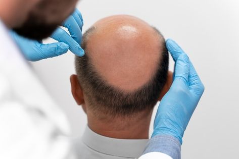 Hair Transplant Cost, Hair Transplant Procedure, Androgenetic Alopecia, Hair Nutrition, Fue Hair Transplant, Hair Transplant Surgery, Best Hair Transplant, Growth Hair, Hair Clinic