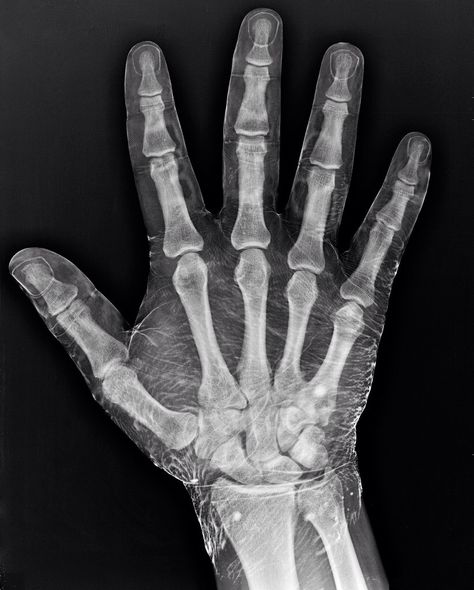 Xray of hand dipped in iodine. - Imgur X Ray Hand, Xray Humor, Hand Anatomy, Radiology Technologist, Hand Reference, Anatomy For Artists, Anatomy Drawing, Wow Art, Mini Lessons