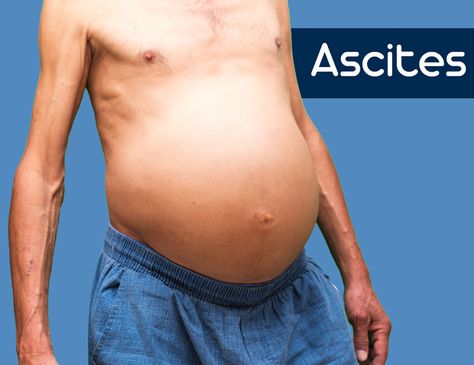 #Ascites is an accumulation of protein-containing (#ascitic) #fluid within the #abdomen. It is considered a frequent complication at the last stage of #liver #disease as well as other fluid #retention conditions like peripheral #edema. The fluid accumulated may also travel to the chest and cause difficulty in #breathing. Islamic New Year Images, Stomach Swelling, Liver Care, Dental Cavities, New Year Images, Homeopathic Medicine, Healthy Detox, Health Nut, Liver Health