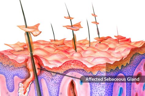 Sebhorric Dermitis Scalp, Sebboric Dermitis Scalp, Sebhorric Dermitis, Seborrheic Dermitis On Face, Seborrheic Dermitis On Scalp, Painful Pimple, Graying Hair, Belly Bloat, Dandruff Remedy